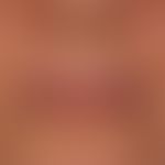 Cheilitis actinica chronica: extensive veil-like leukoplakia of the red of the lips with increase...