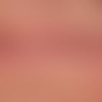 Cheilitis actinica chronica: extensive, non-inflammatory, leukoplakische change of the lip red. a...