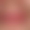 Cheilitis glandularis apostematosa: Oedematous cheilitis with distinct painfulness of the lip; di...