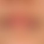 Cheilitis simplex. Rough, reddened, painful lips with erosions, and rhagade formation in a 17-yea...