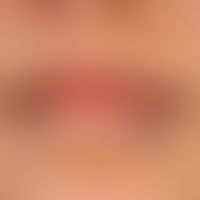 Cheilitis simplex. Rough, reddened, painful lips with erosions, and rhagade formation in a 17-yea...