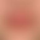 Lip Lick Eczema: Chronic cheilitis with scaling, painful radial rhagades in known atopic diathesi...