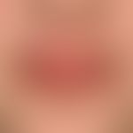 Lip Lick Eczema: Chronic cheilitis with scaling, painful radial rhagades in known atopic diathesi...