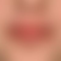 Lip Lick Eczema: Chronic cheilitis with scaling, painful radial rhagades in known atopic diathesi...