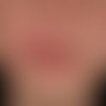 Differenzialdiagnose: Cheilitis simplex

Diagnose: vorliegend eine &nbsp; Cheilitis granulomatosa...