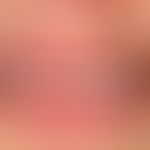 Differenzialdiagnose: Cheilitis simplex

Diagnose: vorliegend eine chronische Cheilitis&nbsp;bei ...