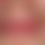 Differenzialdiagnose: Cheilitis simplex

Diagnose: Cheilitis glandularis

