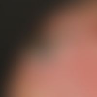 Cornu cutaneum at the base of an actinic keratosis. 75-year-old man with considerable actinic dam...
