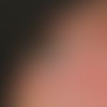 Keratosis actinica vom Typ der Cornu cutaneum:&nbsp; Umschriebenes seit Monaten bestehendes schme...