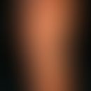 Keratosis palmo-plantaris Unna tose discrete form re sole.jpg
