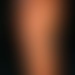 Keratosis palmo-plantaris Unna tose discrete form re sole.jpg
