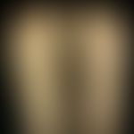 Keratosis plamoplantaris diffusa mit Mutationen in KRT 1: wachsartige diffuse Palmoplantarkeratos...