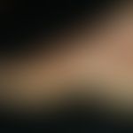 Keratosis palmoplantaris diffusa mit Mutationen in Keratin 1: transgrediente diffuse PKK&nbsp;
