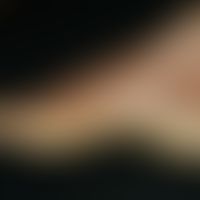 Keratosis palmoplantaris diffusa mit Mutationen in Keratin 1: transgrediente diffuse PKK&nbsp;
