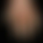 Keratosis palmoplantaris diffusa mit Mutationen in KRT 1: transgrediente diffuse Palmoplantarkera...