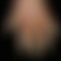Keratosis extremitatum hereditaria transgrediens et progrediens
