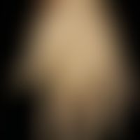 Keratosis palmoplantaris diffusa mit Mutationen in KRT 1: wachsartige diffuse Palmoplantarkeratose
