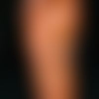 Keratosis palmoplantaris diffusa circumscripta: Flächige gleichförmgie, nicht-transgrediente, dif...