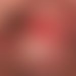 Erythroplasia. solitary, chronically dynamic, about 2 cm in size, sharply defined, clearly increa...