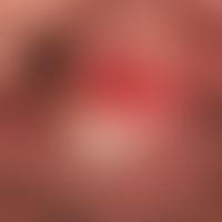 Erythroplasie. Solitäre, chronisch dynamische, etwa 2 cm große, scharf begrenzte, deutlich konsis...