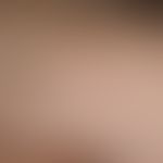 Atrophische Narben bei Ehlers-Danlos-Syndrom
