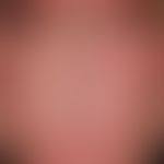Exfoliatio areata linguae. 2 anular, "plaque free" areas. low burning sensation with spicy food o...