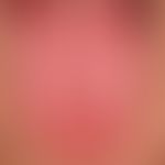 Lingua plicata mit ausgeprägter Exfoliatio areata linguae (durchaus nicht selten auftretende Komo...