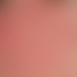 Erythema perstans faciei. Persistierende, symptomarme, symmetrisch angeordnete Gesichtsrötung. Ke...