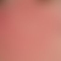 Erythema perstans faciei. Persistierende, symptomarme, symmetrisch angeordnete Gesichtsrötung. Ke...
