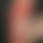 hand-foot syndrome: occurred under therapy with tyrosine kinase inhibitor. painful, extensive, pe...