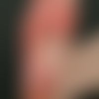 hand-foot syndrome: occurred under therapy with tyrosine kinase inhibitor. painful, extensive, pe...