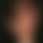 hand-foot syndrome: occurred under therapy with tyrosine kinase inhibitor. painful, extensive, pe...