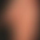 Erythromelalgie. Anfallsweise auftretende, sehr schmerzhafte, hyperämische, gerötete und geschwol...