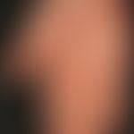Erythromelalgie. Anfallsweise auftretende, sehr schmerzhafte, hyperämische, gerötete und geschwol...