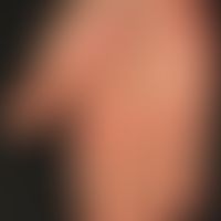 Erythromelalgie. Anfallsweise auftretende, sehr schmerzhafte, hyperämische, gerötete und geschwol...