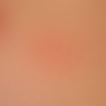 Erythema anulare centrifugum: Charakteristische Einzelläsion mit peripher fortschreitenden Plaque...