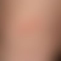 Erythema anulare centrifugum: Characteristic single cell lesion with peripherally progressive pla...