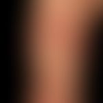 Erythema anulare centrifugum: Großflächige, polyzyklisch begrenzte,&nbsp;symptomlose, scharf begr...