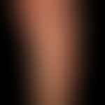 Erythema anulare centrifugum: Großflächige, polyzyklisch begrenzte,&nbsp;symptomlose&nbsp;breite ...