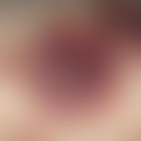 Ecchymosis syndrome, painful. intermittent manifestation of painful skin bleeding in a 52-year-ol...