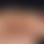 Ekchymosen-Syndrom, schmerzhaftes. Schubweise Manifestation schmerzhafter, nachweislich nicht tra...