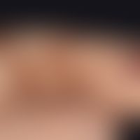ecchymosis syndrome, painful. intermittent manifestation of painful, demonstrably non-traumatic i...