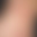 Erythema gyratum repens:&nbsp;Chronisch dynamische (seit&nbsp;mehreren Monaten wechselhafter Verl...