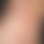 Erythema gyratum repens. chronic dynamic (changeable course for several months), linear, symptom-...