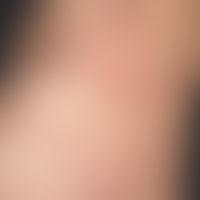 Erythema gyratum repens. chronic dynamic (changeable course for several months), linear, symptom-...