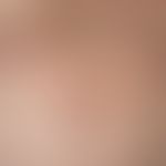 Erythema gyratum repens. chronic dynamic (changeable course for several months), linear, symptom-...
