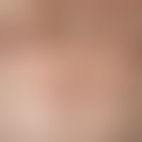 Erythema gyratum repens. chronic dynamic (changeable course for several months), linear, symptom-...