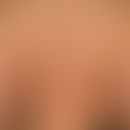 Psoriasis Erythema anulare centrifugum-artige: Chronische, schubweise verlaufende, anuläre&nbsp;P...