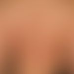 Psoriasis erythema anulare centrifugum-like: Chronic, intermittent, anular psoriasis with sharply...