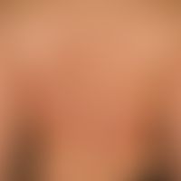 Psoriasis erythema anulare centrifugum-like: Chronic, intermittent, anular psoriasis with sharply...